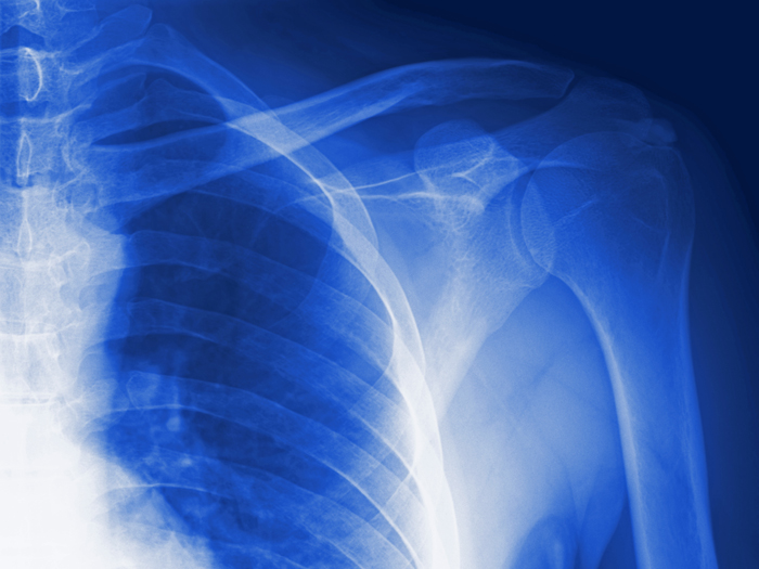 shoulder xray